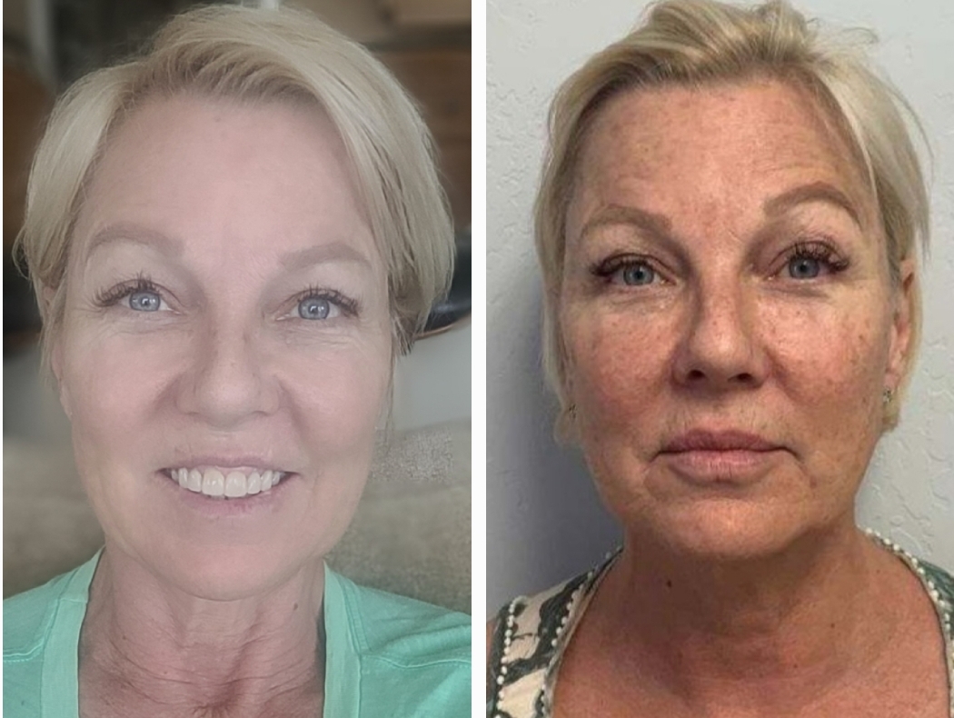 Before and after IPL Photofacial — dramatic reduction in sun damage, age spots and uneven skin tone